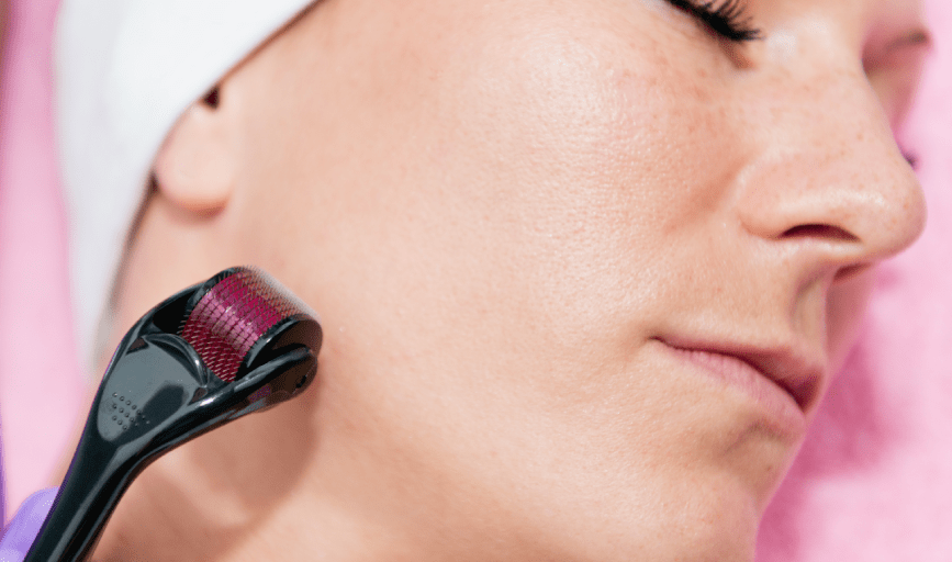 MICRONEEDLING